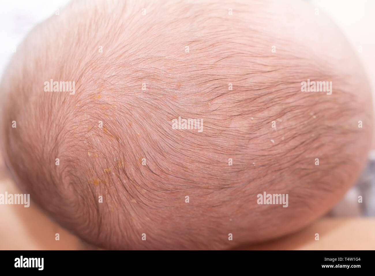 Neugeborene Kopf mit Aufnahmevorrichtung Kappe oder infantile seborrhoische Dermatitis. Neugeborene Kopf mit seborrhoe. Stockfoto