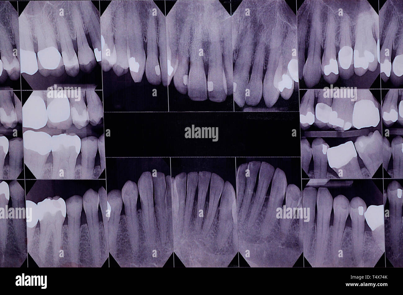 Ein X-ray der Zähne, zusammengesetzten von jedem Zahn, Kronen und Archivierungen zahnmedizinische Gesundheit zu bewerten oder Ihre Identität bestätigen. Stockfoto