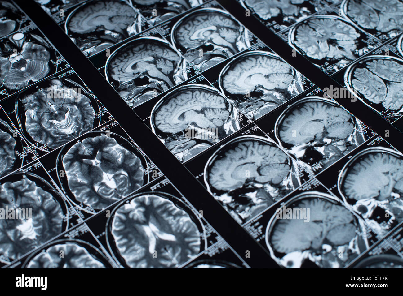 Mrt-Brain Scan von Kopf und Schädel Stockfoto