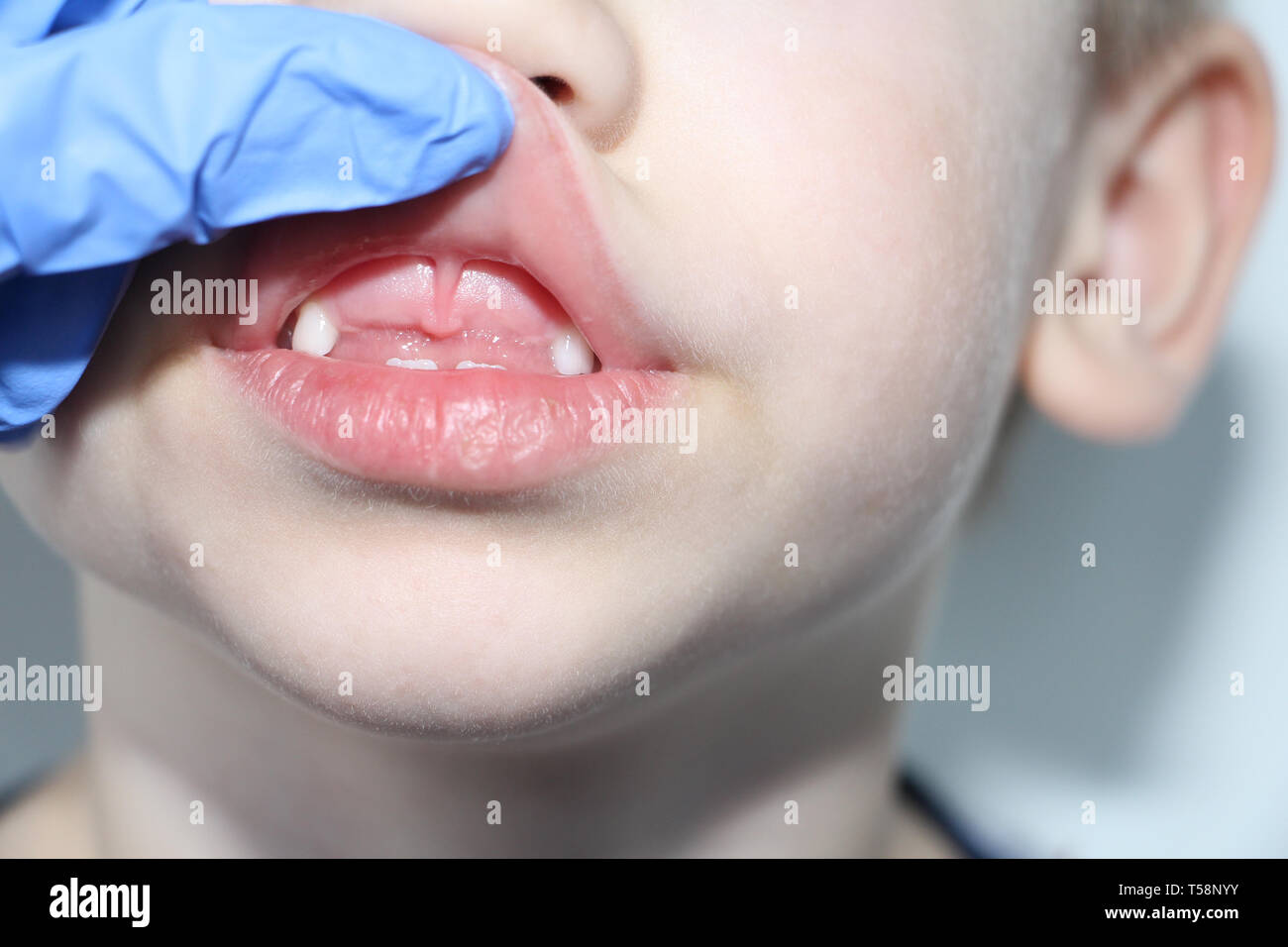 Die Oberen Zahne Stockfotos Und Bilder Kaufen Alamy