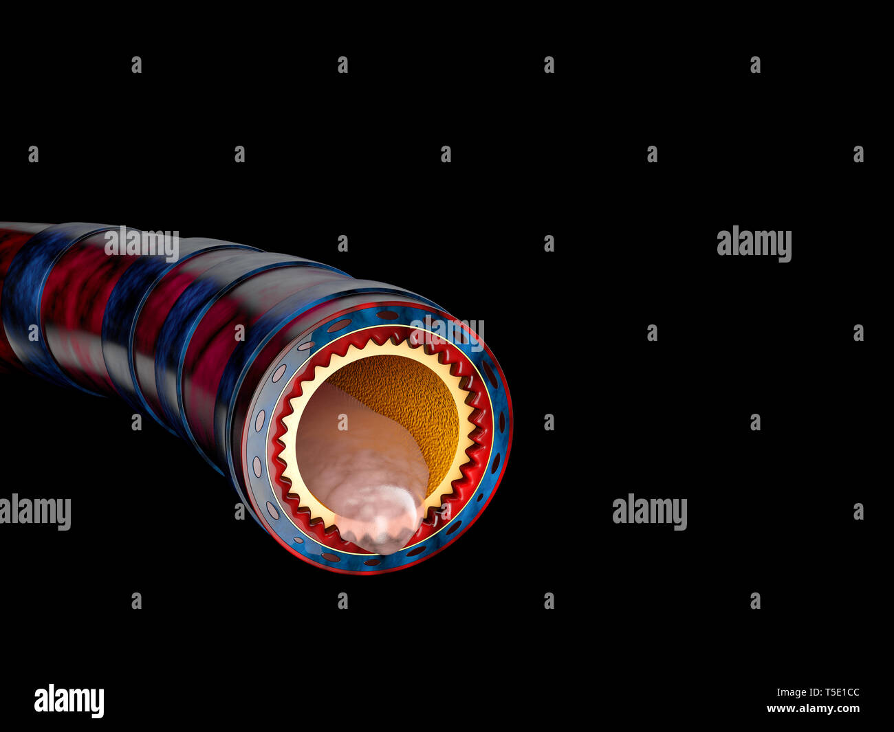 Bronchitis Anatomie, Schleim abgesondert als Brust kalt wie eine 3D-Darstellung. Stockfoto