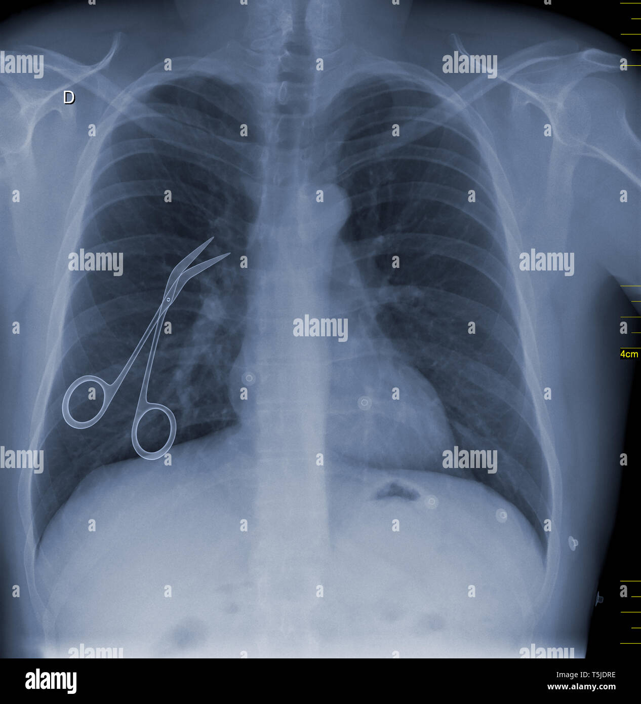 3D-Rendering eines konzeptionellen Bild der medizinischen Verfehlung vertreten mit chirurgische Scheren innerhalb eines Patienten nach der Operation links Stockfoto