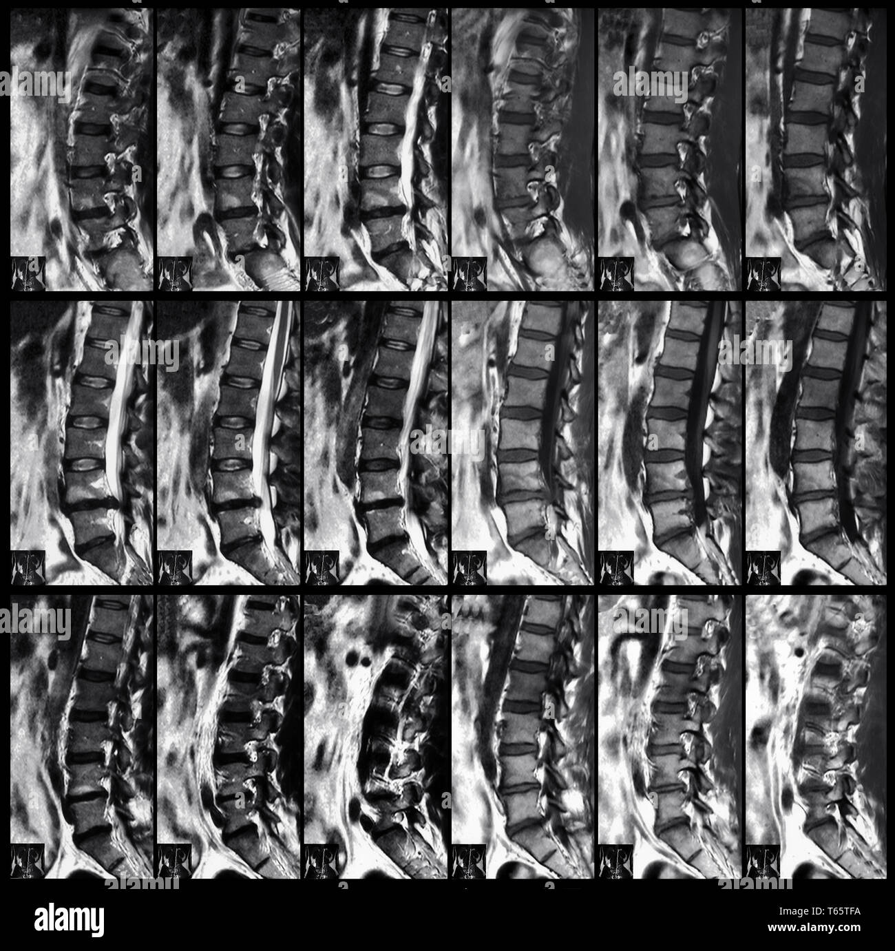 X-ray der Wirbelsäule Stockfoto