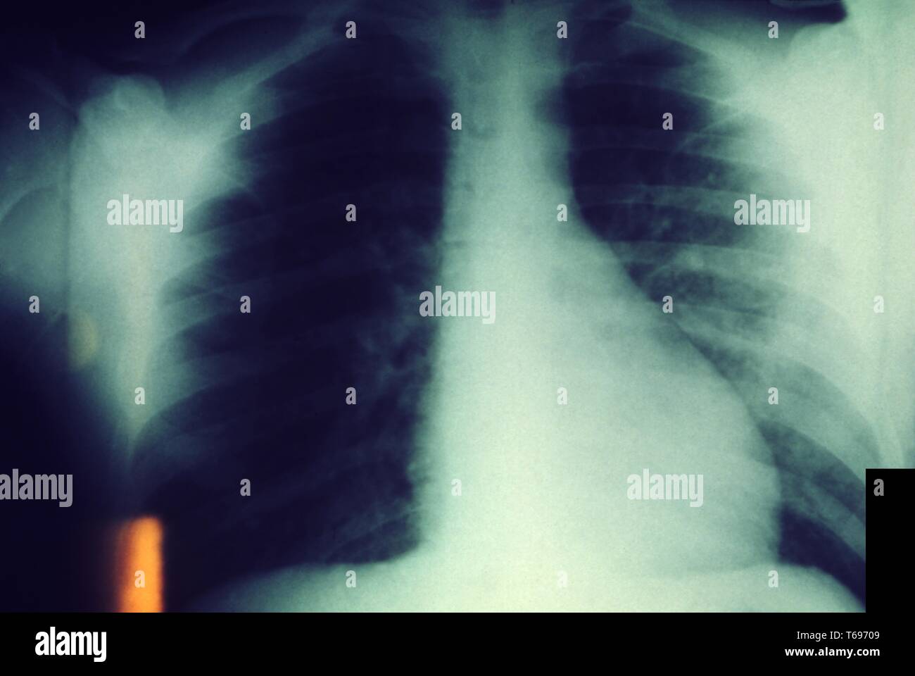 Brust Röntgenbild zeigt eine bilaterale pulmonale Infektionen durch dieses Opfer mit einer stärkeren Infektion in der linken Lunge, 1975 die Pest. Bild mit freundlicher Genehmigung Zentren für Krankheitskontrolle und Prävention (CDC)/Dr Jack Polen. () Stockfoto