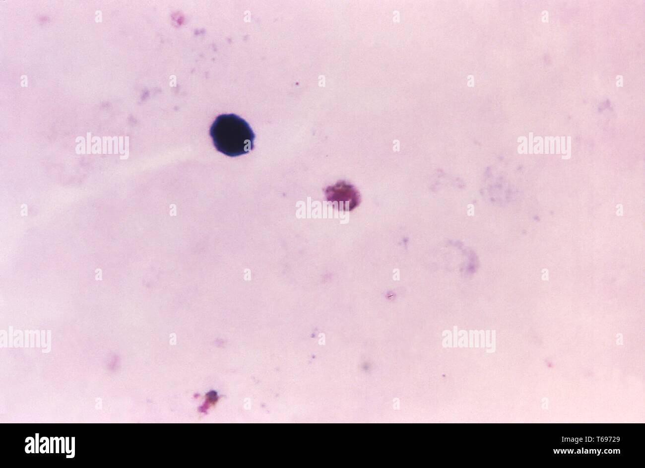 Giemsa Fleck Thick Film photomicrograph eines Plasmodium malariae gametocyte, 1969. Bild mit freundlicher Genehmigung Zentren für Krankheitskontrolle und Prävention (CDC)/Dr Mae Melvin. () Stockfoto