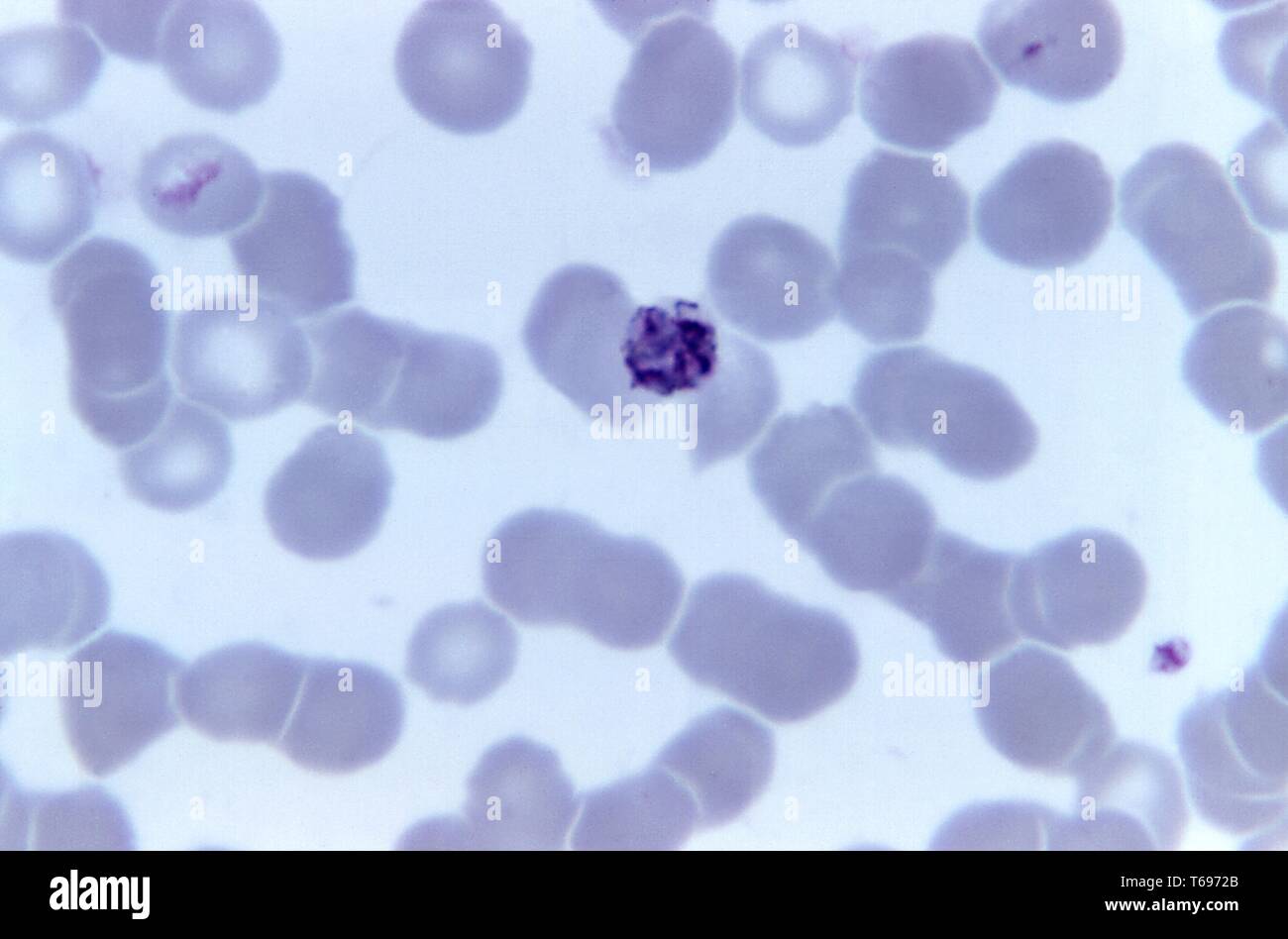 Giemsa Fleck photomicrograph eines alten unreifen Plasmodium malariae schizont, 1973. Bild mit freundlicher Genehmigung Zentren für Krankheitskontrolle und Prävention (CDC)/Dr Mae Melvin. () Stockfoto