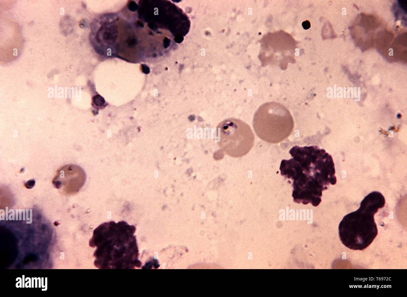 Ölkapselung photomicrograph einer Leber gewebe infiziert mit Plasmodium malariae, die bei der Autopsie, 1969 übernommen. Bild mit freundlicher Genehmigung Zentren für Krankheitskontrolle und Prävention (CDC)/Neva Gleason. () Stockfoto