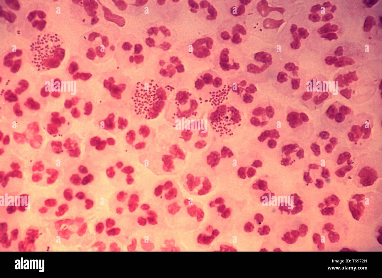 Gram-Fleck photomicrograph der Histopathologie in einem akuten Fall von gonococcal Urethritis, 1979. Bild mit freundlicher Genehmigung Zentren für Krankheitskontrolle und Prävention (CDC)/Joe Millar. () Stockfoto