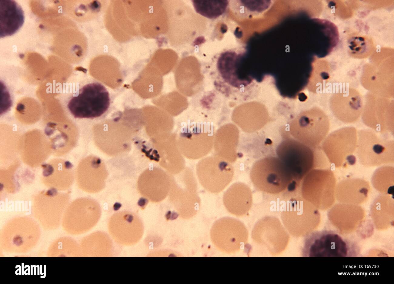 Ölkapselung photomicrograph einer Leber gewebe infiziert mit Plasmodium malariae, die bei der Autopsie, 1969 übernommen. Bild mit freundlicher Genehmigung Zentren für Krankheitskontrolle und Prävention (CDC)/Neva Gleason. () Stockfoto