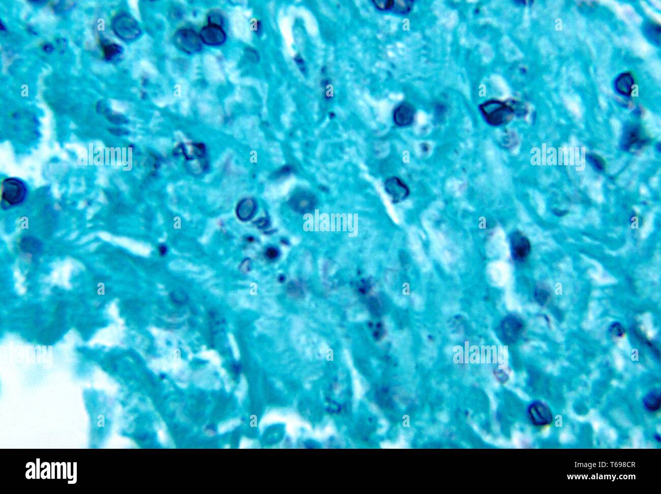 Methenamin silber Fleck photomicrograph des histopathologic Veränderungen in der Histoplasmose durch die dimorphic Pilz Histoplasma capsulatum, 1972 verursacht. Bild mit freundlicher Genehmigung Zentren für Krankheitskontrolle und Prävention (CDC)/Dr Libero Ajello. () Stockfoto