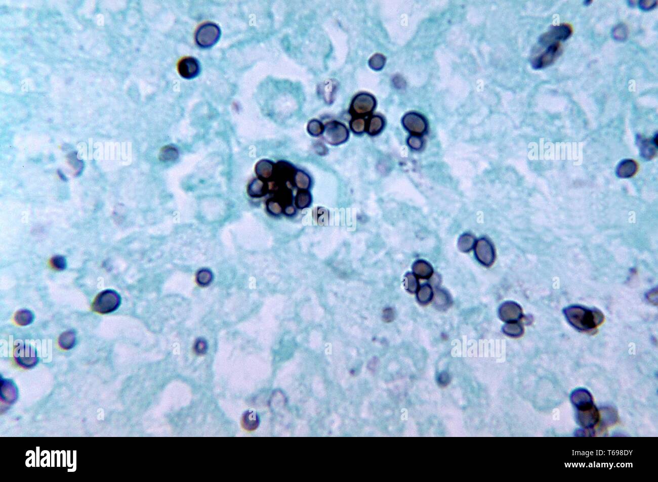 Methenamin silber Fleck photomicrograph des histopathologic Veränderungen in der Histoplasmose durch die dimorphic Pilz Histoplasma capsulatum, 1972 verursacht. Bild mit freundlicher Genehmigung Zentren für Krankheitskontrolle und Prävention (CDC)/Dr Libero Ajello. () Stockfoto