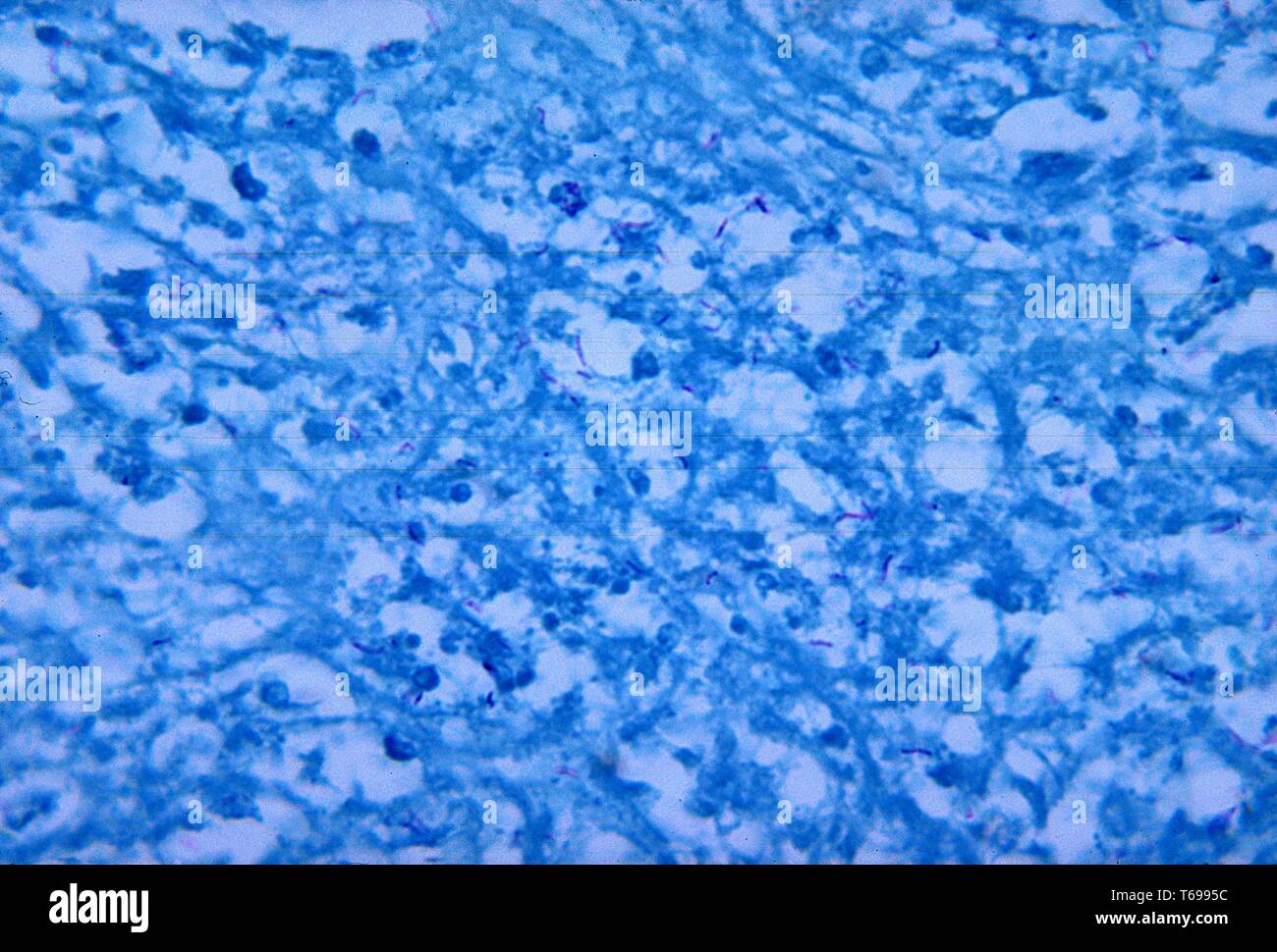 Diese histopathologic photomicrograph zeigt die Änderungen aufgrund von nokardiose einer Mesenterialen Lymphknoten mit einem Ffn Fleck, 1965. 80 % der Fälle von nokardiose zeigen klinische Merkmale der invasiven pulmonalen Infektion, verbreitet Krankheit, oder hirnabszesse, 20% zeigen Cellulitis. In etwa einem Drittel der Personen, kann die Infektion verbreiten die regionalen Lymphknoten zu beteiligen. Bild mit freundlicher Genehmigung von CDC/Dr. Martin Hicklin. Stockfoto