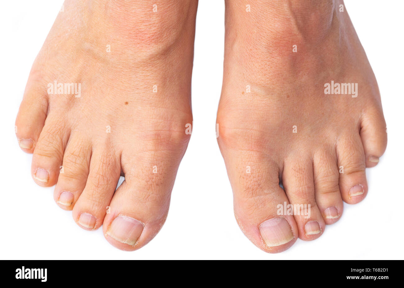 Die Füße der Frau mit schmerzhaften Hallux Valgus Stockfoto