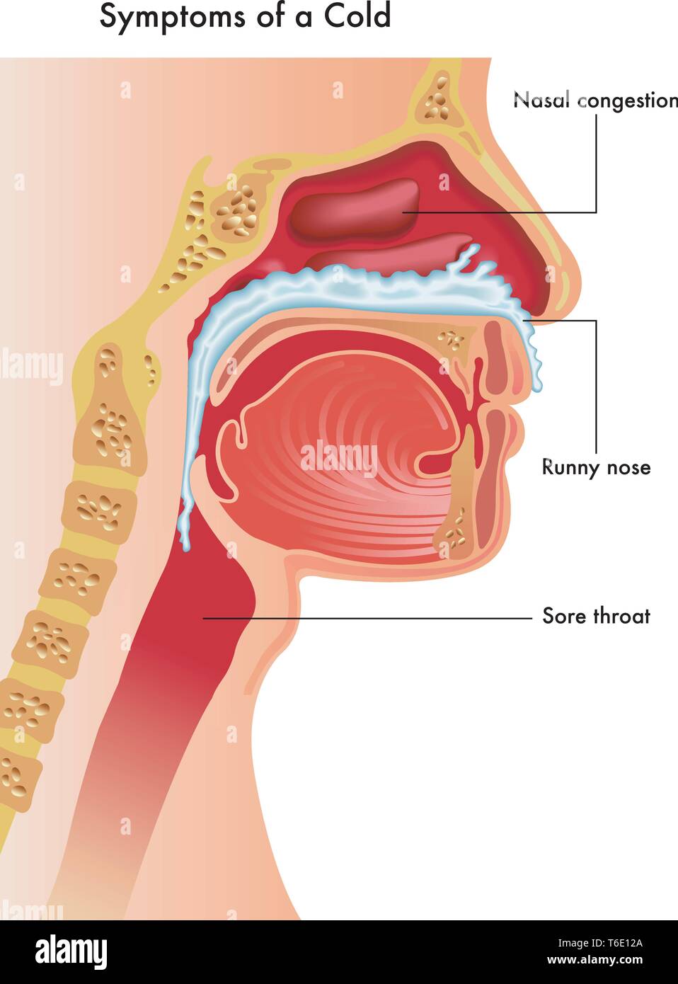 Eine medizinische Illustration der der oberen Atemwege einer Person mit den Symptomen einer Erkältung. Stock Vektor