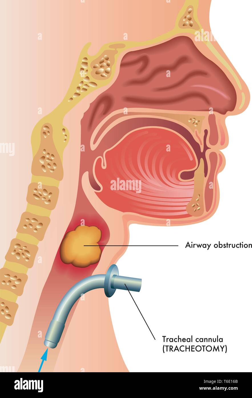Medizinische Illustration eines chirurgischen Tracheotomie Stock Vektor