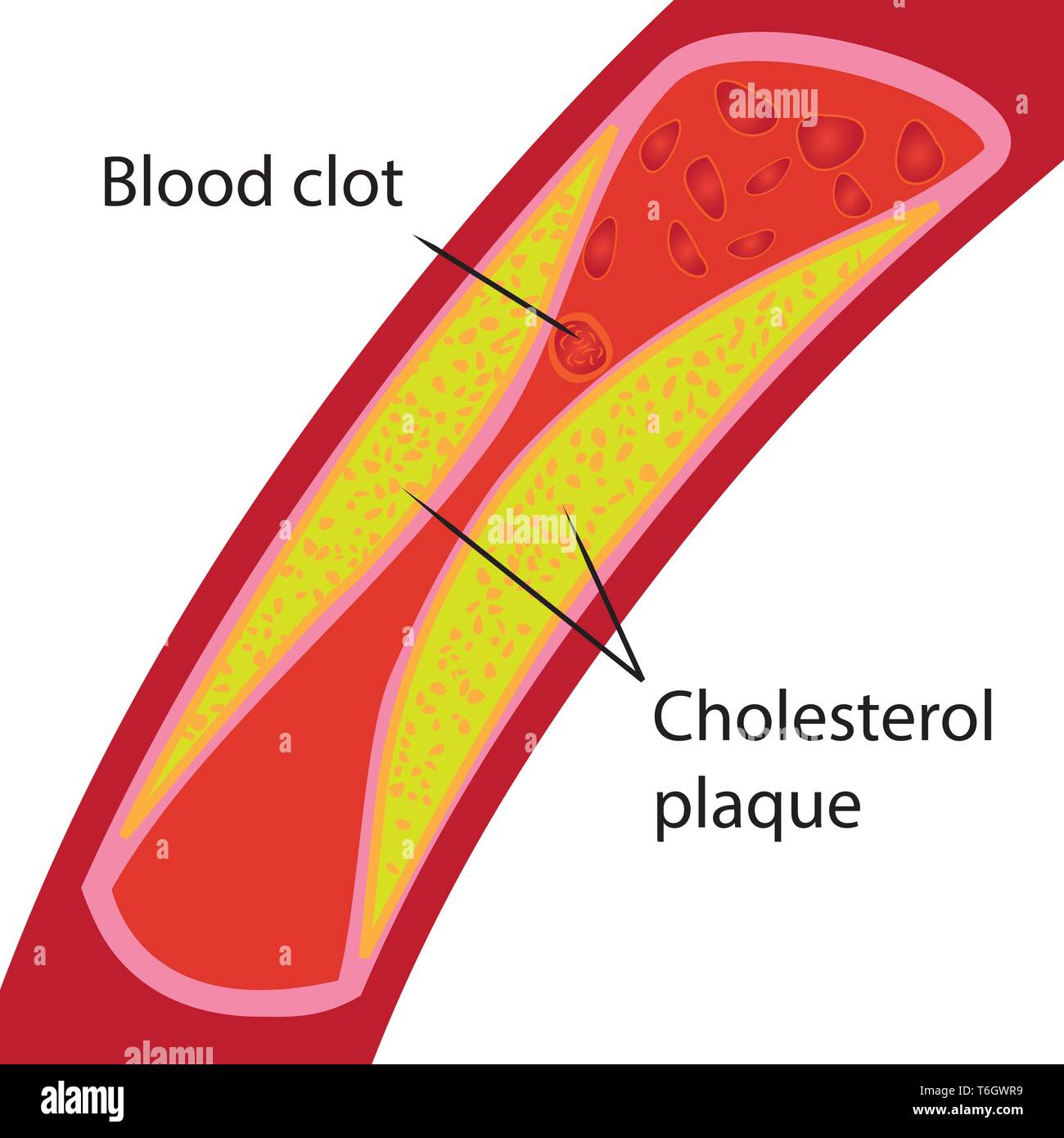 Blutgerinnsel und Cholesterin Plakette. Verstopfte Blutgefäß Abbildung auf weißem Hintergrund Stock Vektor
