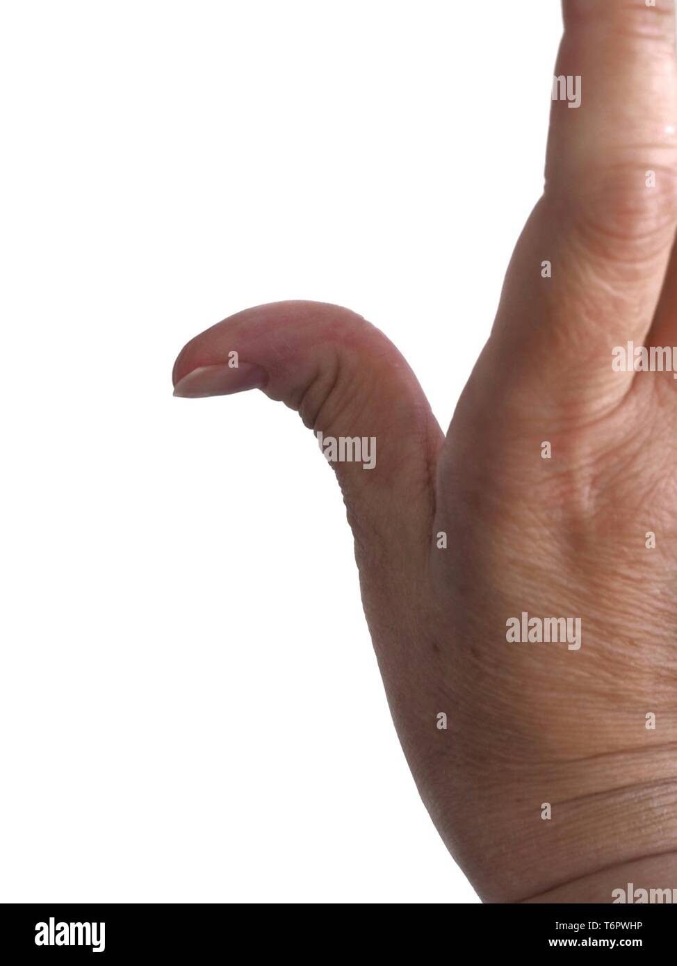 Eine gebogene Daumen. Tramper Daumen, distalen hyperextensibility. Stockfoto