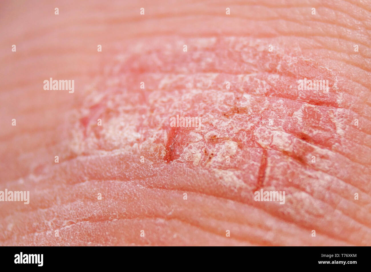 Psoriasis makro -Fotos und -Bildmaterial in hoher Auflösung – Alamy
