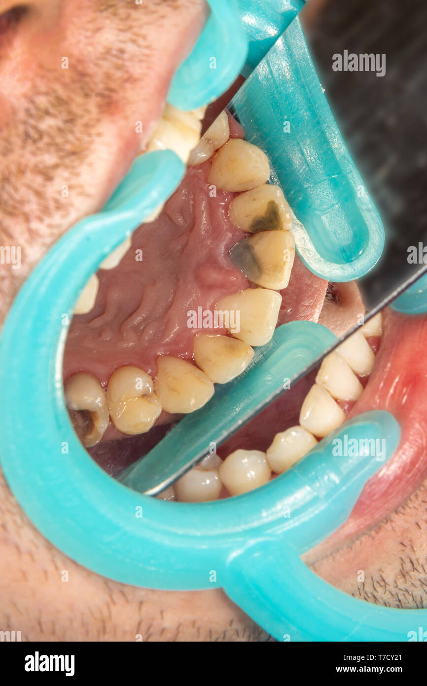 Menschliche Zähne mit Karies und Pol. Close-up Makro zahnmedizinische Klinik. Behandlung Konzept Stockfoto