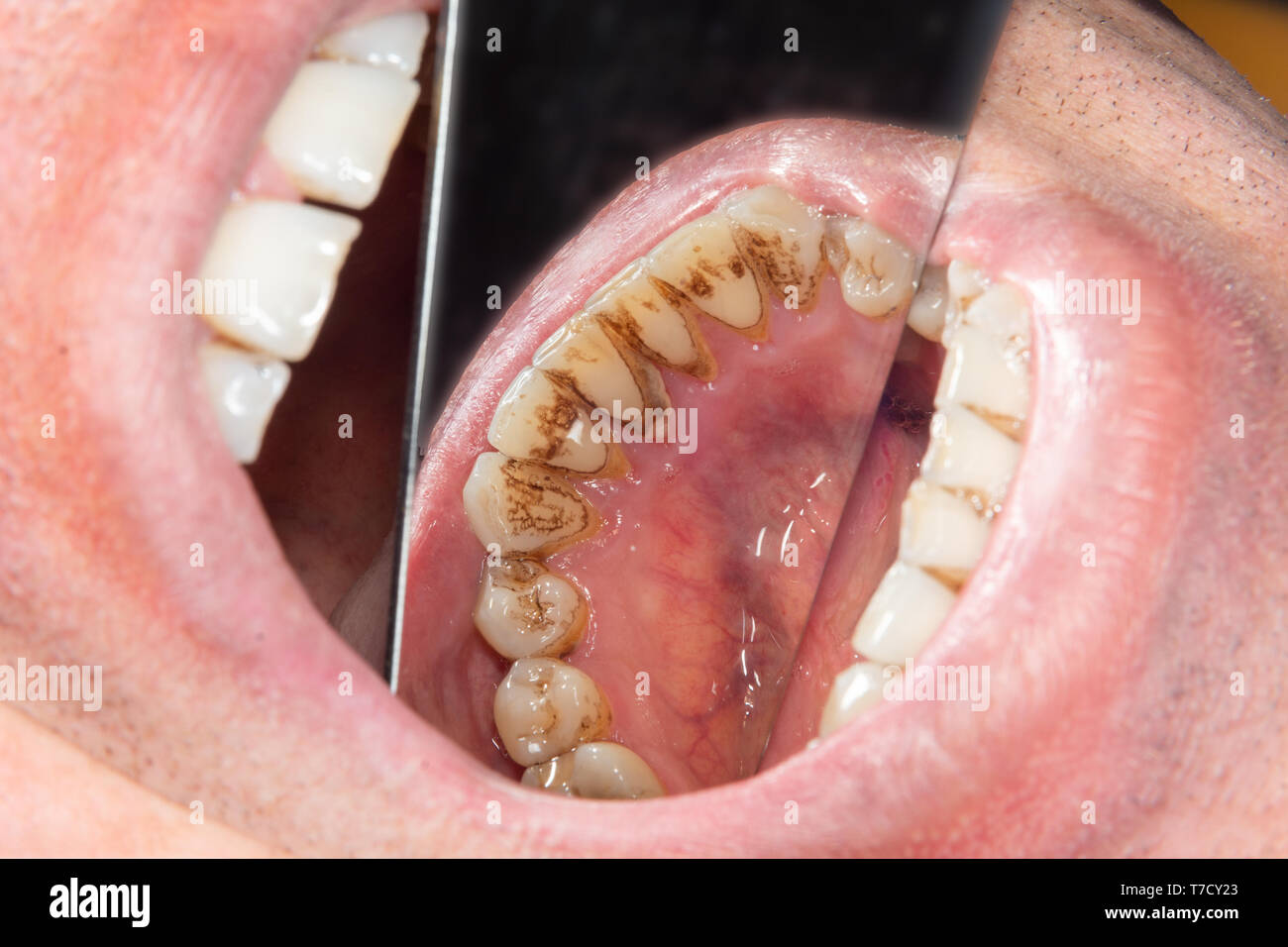 Menschliche Zähne mit Rauchen Plaque und Zahnstein. Close-up Makro zahnmedizinische Klinik. Hygiene Konzept Stockfoto