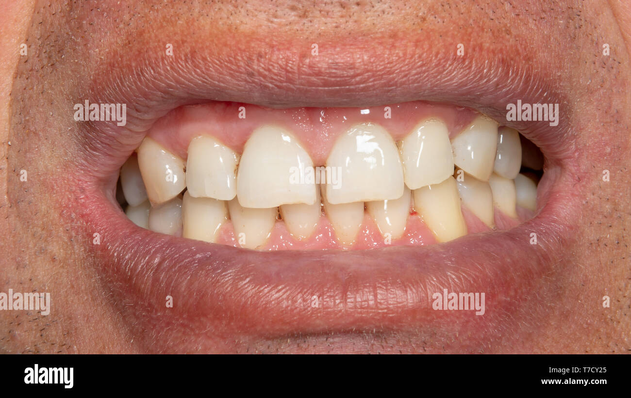 Menschliche Zähne mit Rauchen Plaque und Zahnstein. Close-up Makro zahnmedizinische Klinik. Hygiene Konzept Stockfoto