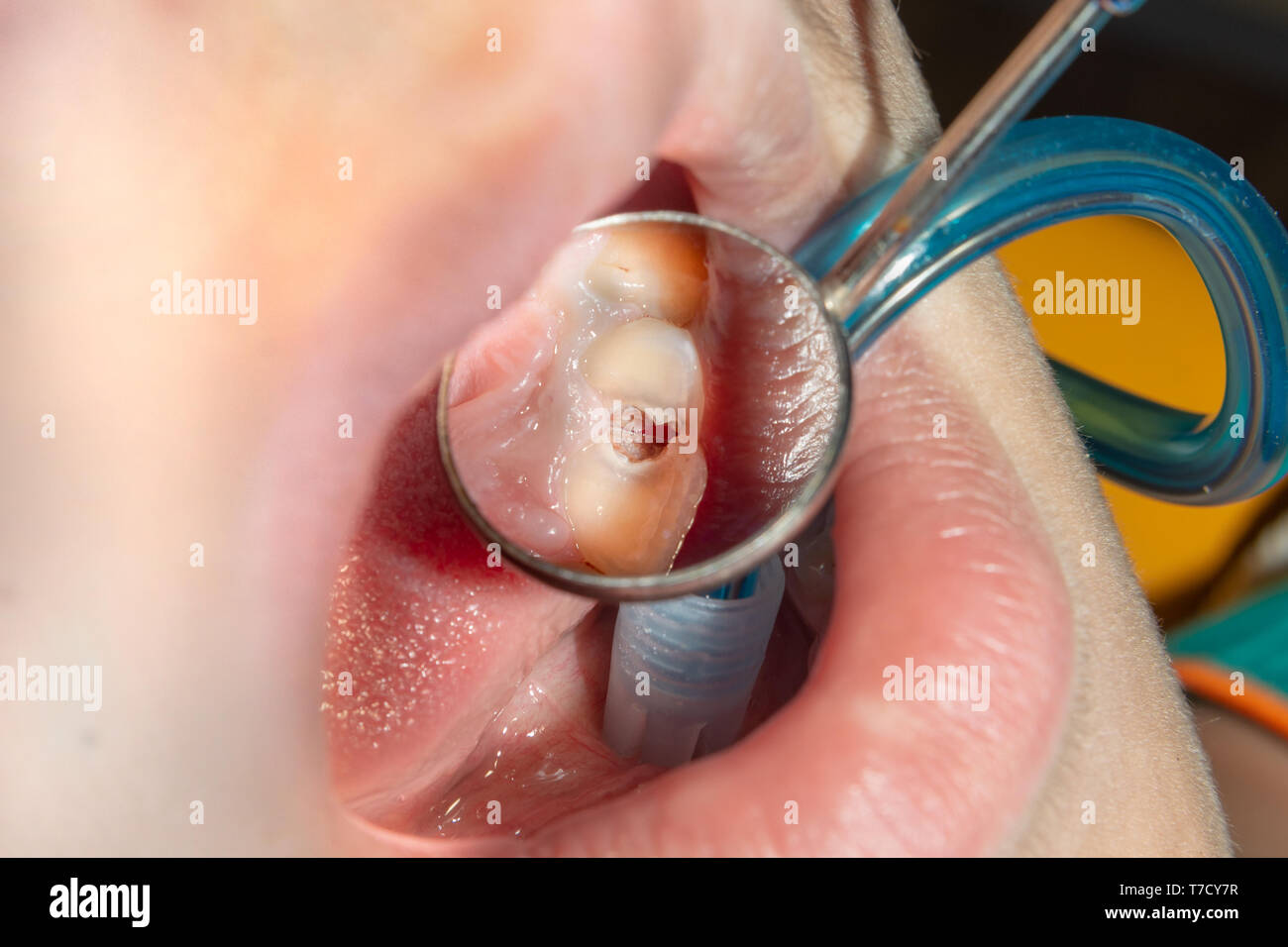 Menschliche Zähne mit Karies und Pol. Close-up Makro zahnmedizinische Klinik. Behandlung Konzept Stockfoto