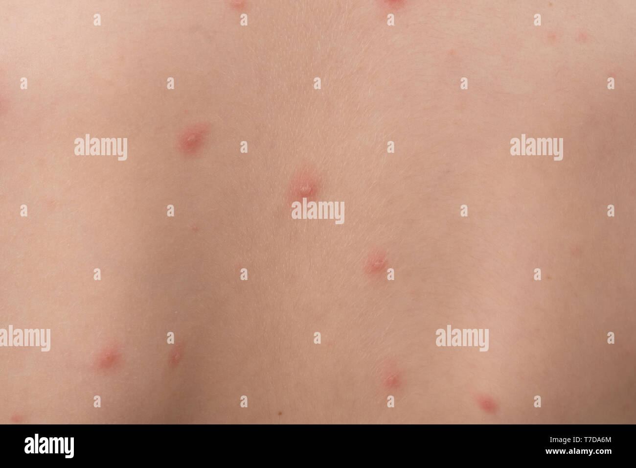 Varicella Zoster Infection Stockfotos Und Bilder Kaufen Alamy