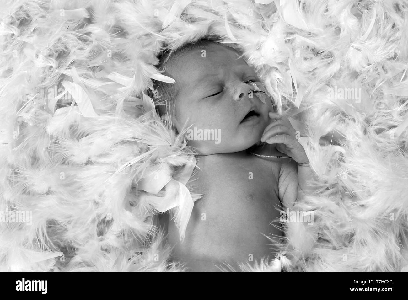 Frühgeborenes Baby Mädchen mit Einfüllöffnung, NG-Sonde Stockfoto