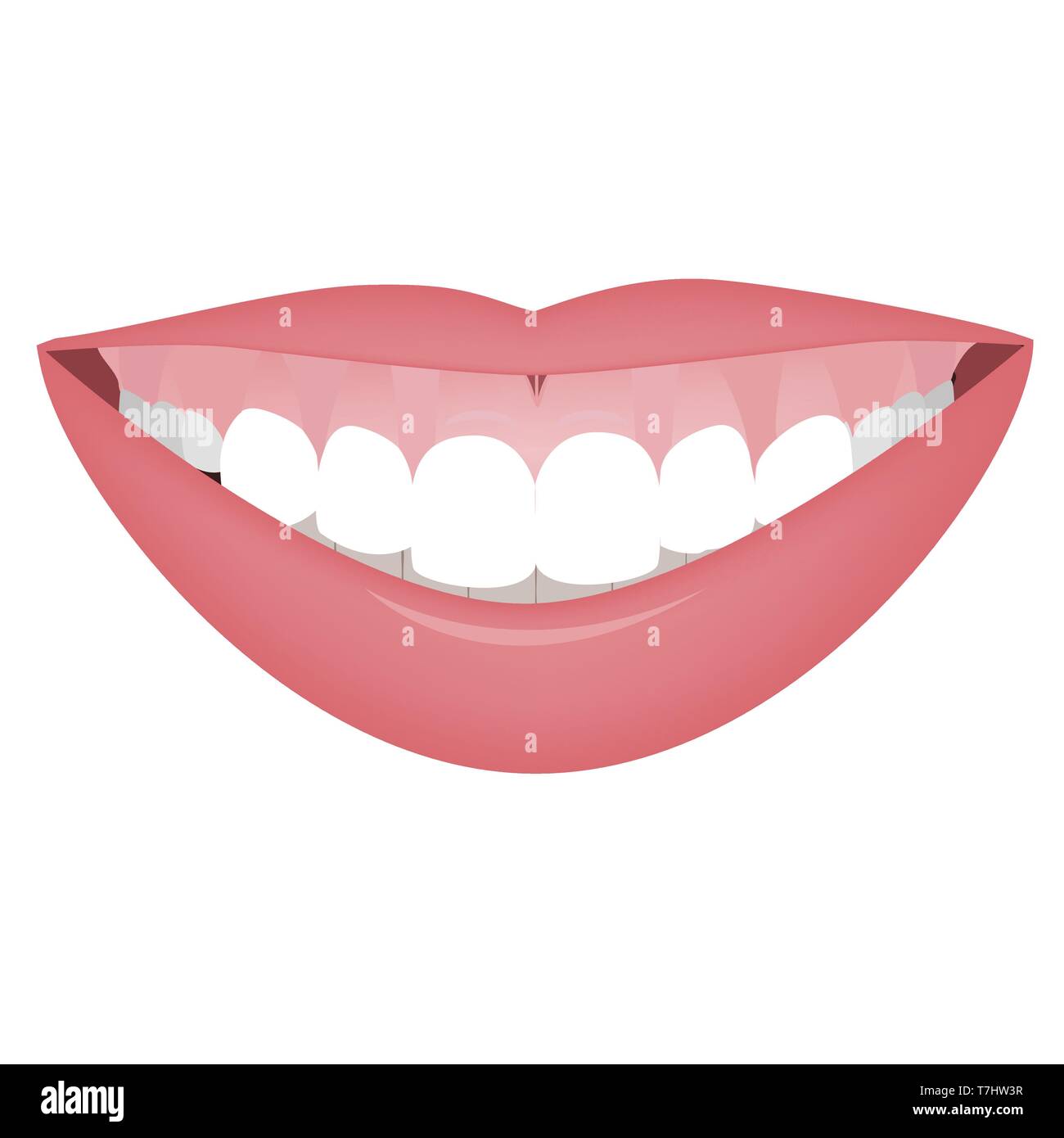 Mund mit einem hohen Lächeln oder gummiartiges Lächeln vor der Kosmetik, orthotropics orthotropics oder Korrektur. Vector Illustration Stock Vektor