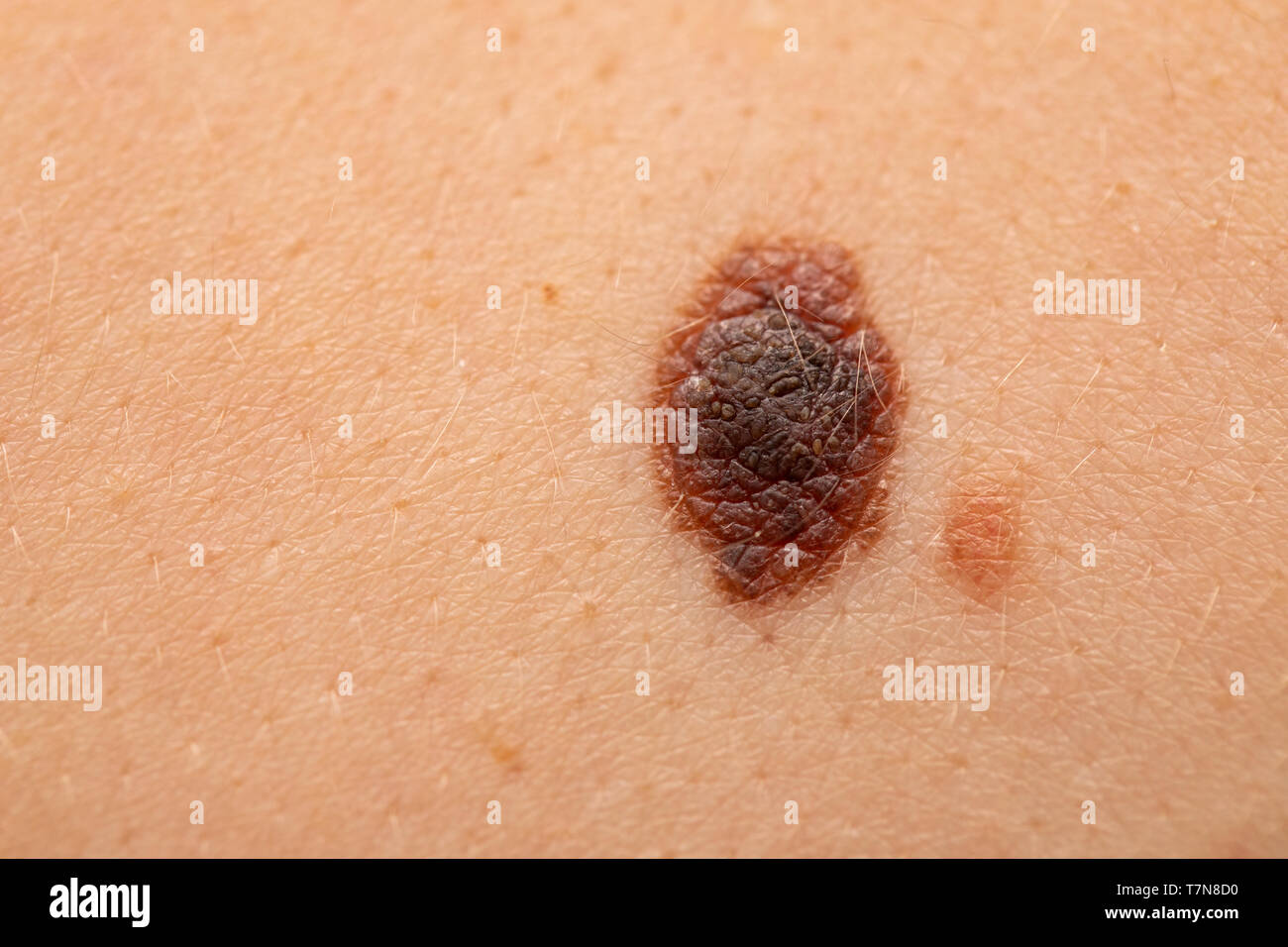 In der Nähe Bild von gefährlichen braunen Muttermale auf der menschlichen Haut - Melanom Stockfoto