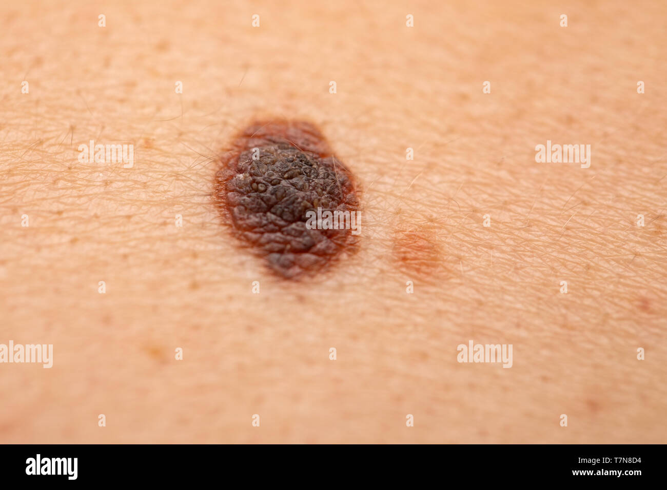 In der Nähe Bild von gefährlichen braunen Muttermale auf der menschlichen Haut - Melanom Stockfoto