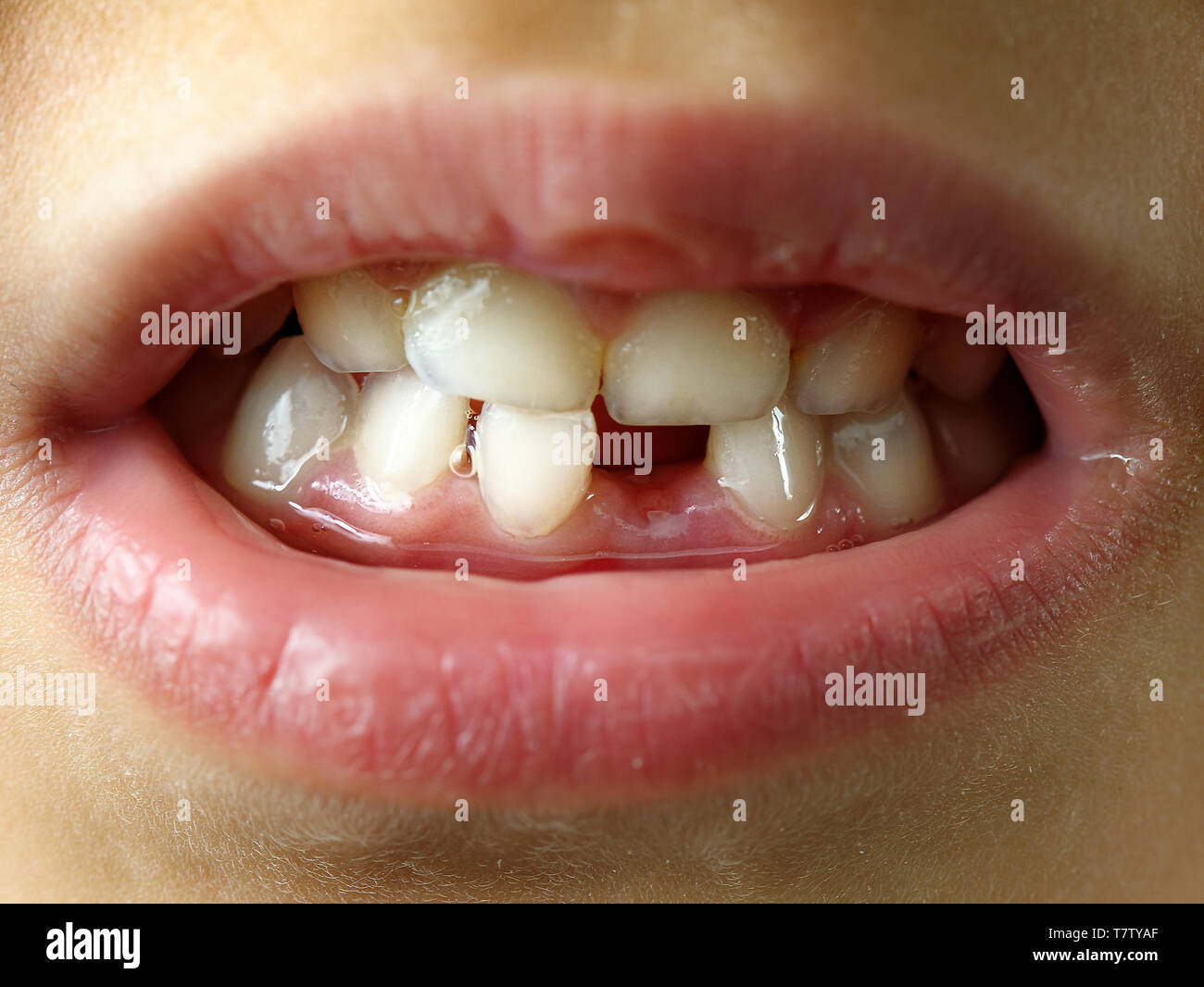 Fehlender Zahn lächeln Kind oder Kinder Mund closeup oder Makro Stockfoto