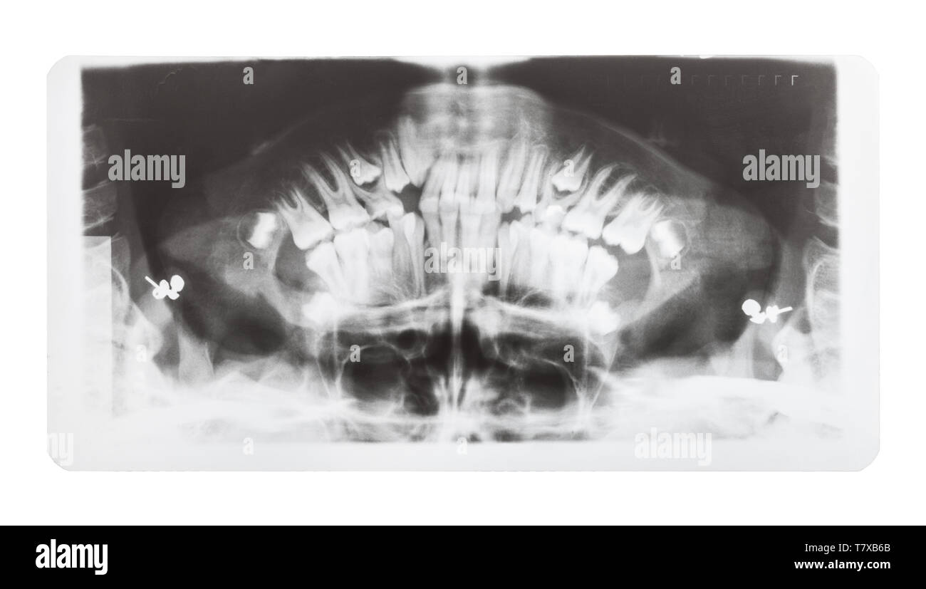 Film mit X-ray Bild der menschlichen Kiefer auf weißem Hintergrund Stockfoto
