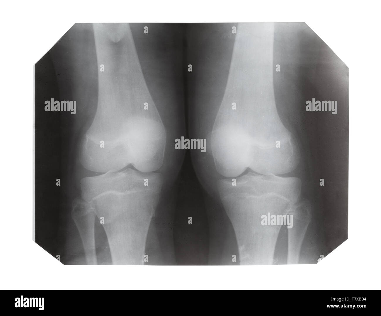 Film mit X-ray Bild der Vorderseite von zwei menschlichen Knie auf weißem Hintergrund Stockfoto