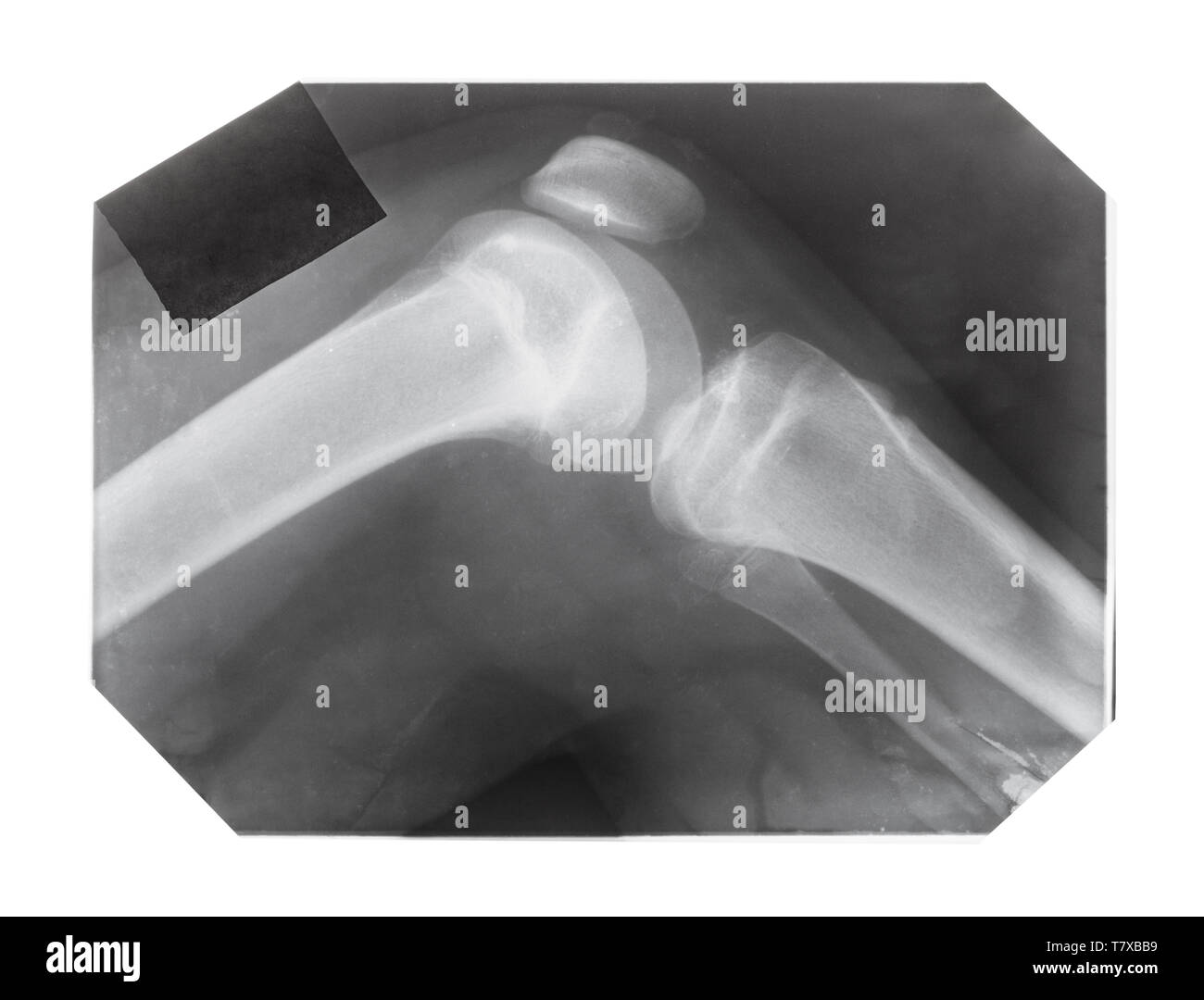 Film mit X-ray Bild des menschlichen Kniegelenks mit patella auf weißem Hintergrund Stockfoto