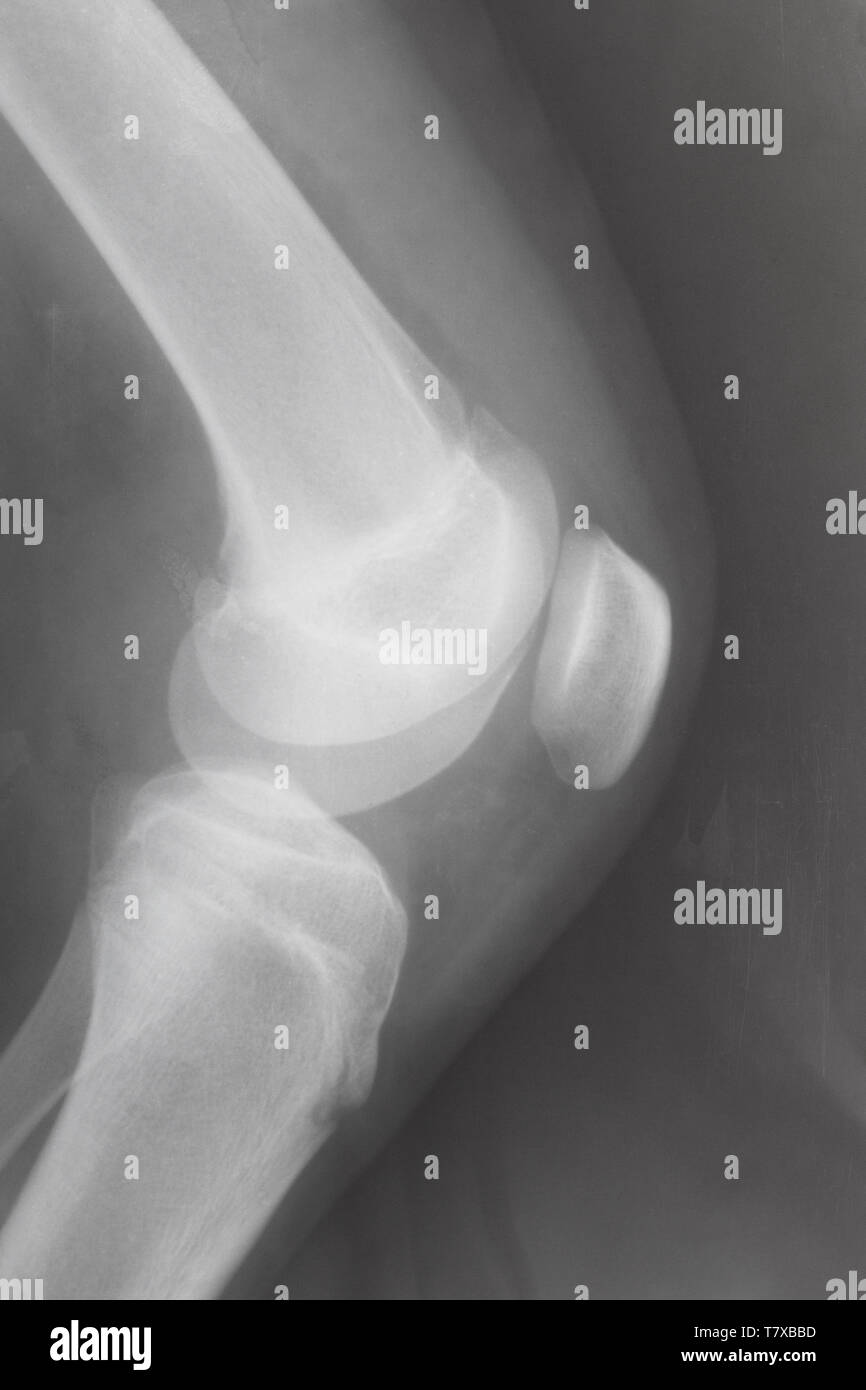 Seitenansicht des menschlichen Knie-Gelenk mit kniescheibe auf X-ray Image Stockfoto