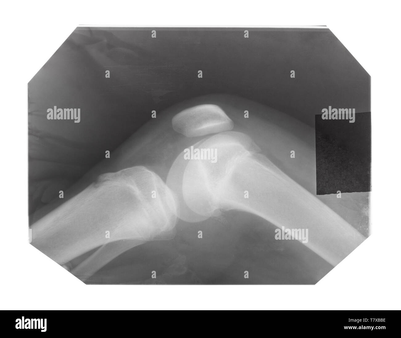 Film mit X-ray Bild des menschlichen Knie-Gelenk mit kniescheibe auf weißem Hintergrund Stockfoto