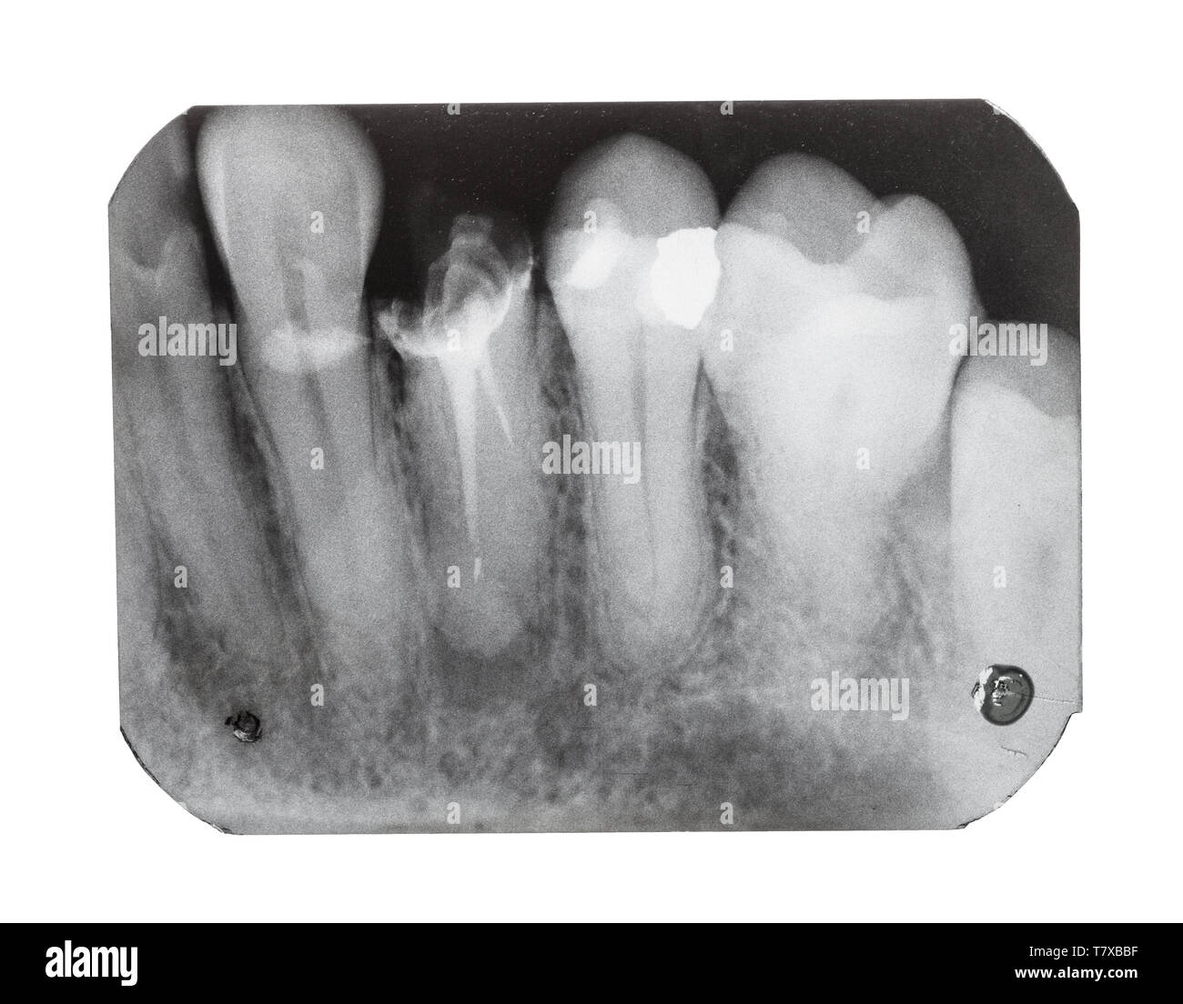 Film mit X-ray Bild der menschlichen Zähnen mit zahnmedizinischen Pin close up auf weißem Hintergrund Stockfoto