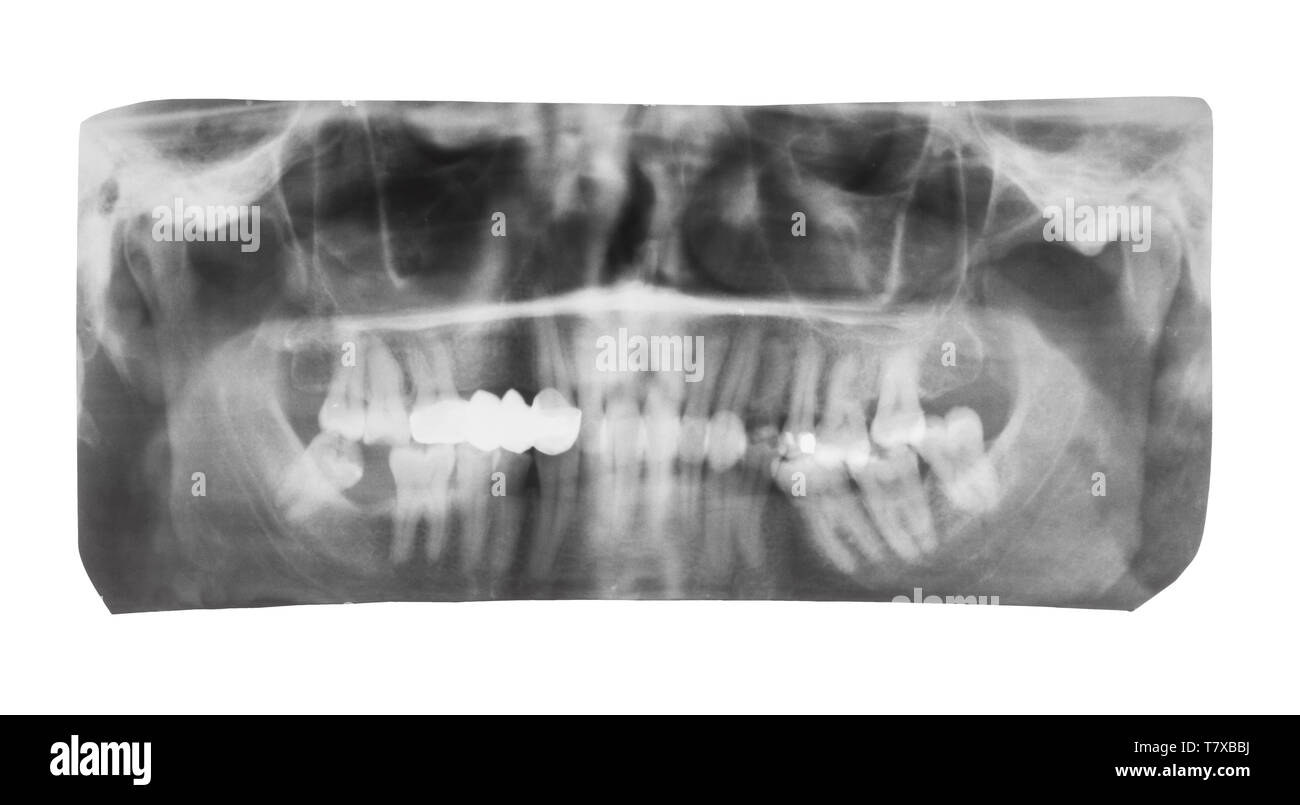 Film mit X-ray Bild der menschlichen Backen mit zahnmedizinischen Krone auf die Zähne auf weißem Hintergrund Stockfoto