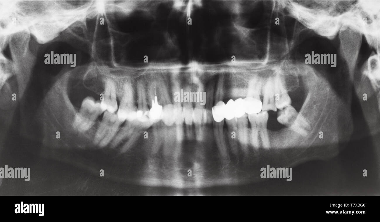 Vorderansicht des menschlichen Backen mit zahnmedizinischen Krone und die Stifte in die Zähne auf X-ray Image Stockfoto