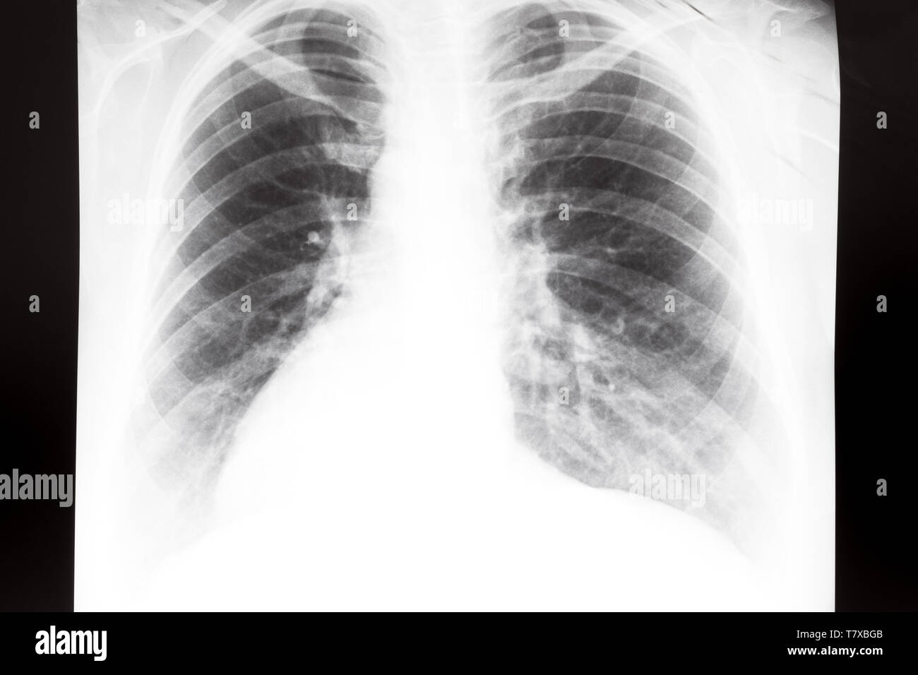 Vorderansicht des menschlichen Thorax mit Lungen auf X-ray Image Stockfoto