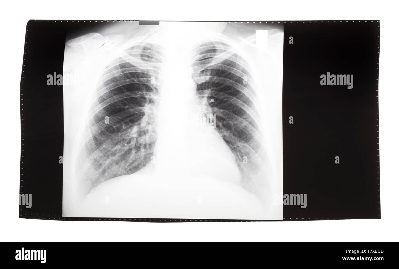 Film mit X-ray Image der Vorderansicht des menschlichen Thorax auf weißem Hintergrund Stockfoto