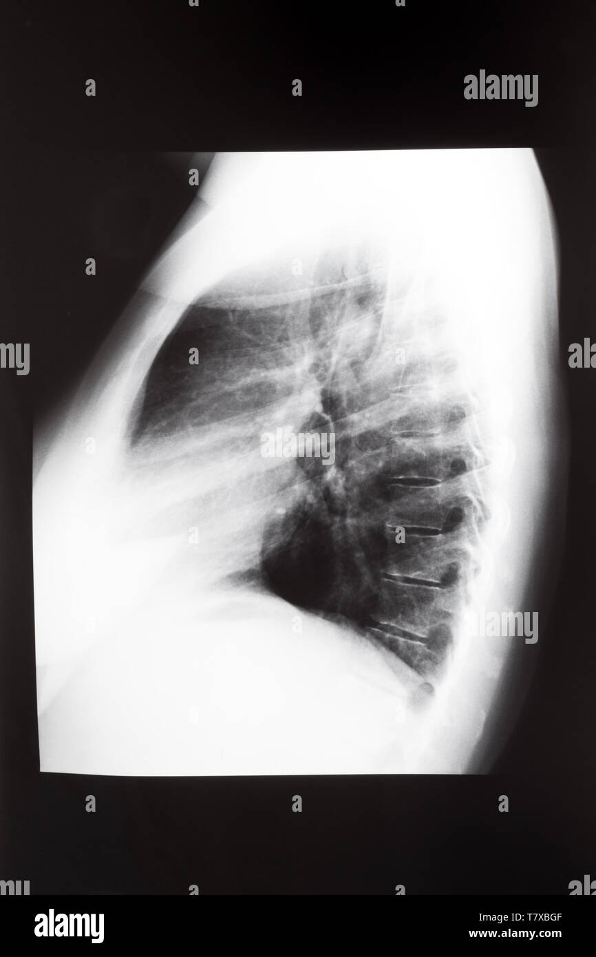 Seitenansicht des menschlichen Thorax mit Lungen auf X-ray Image Stockfoto