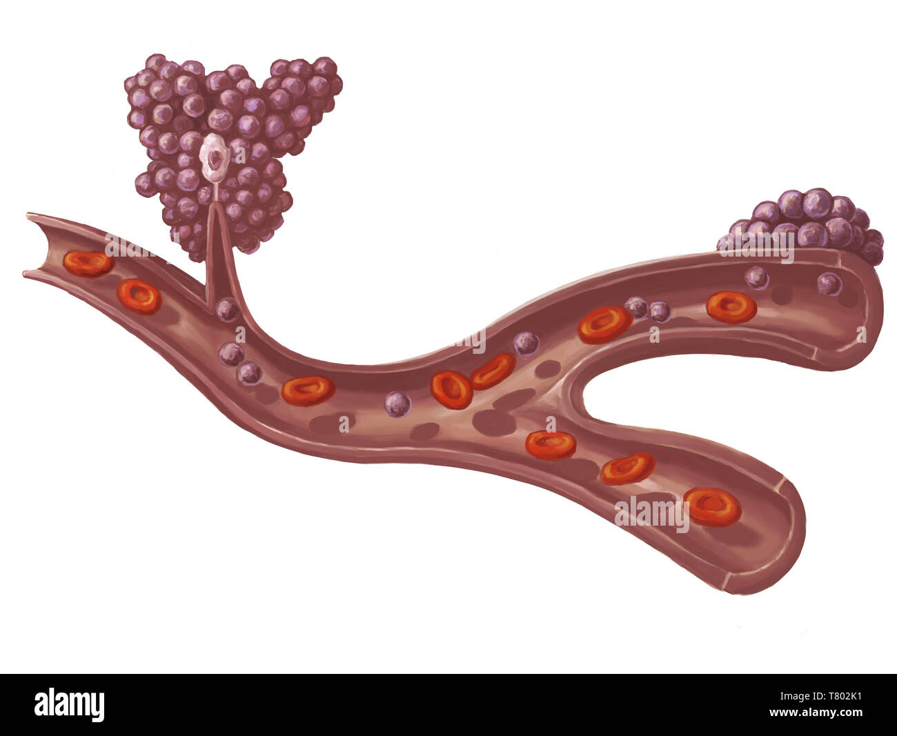 Metastasen eines Tumors, Abbildung Stockfoto