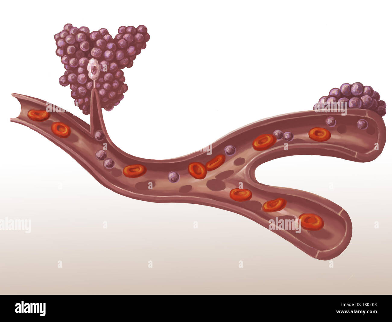 Metastasen eines Tumors, Abbildung Stockfoto
