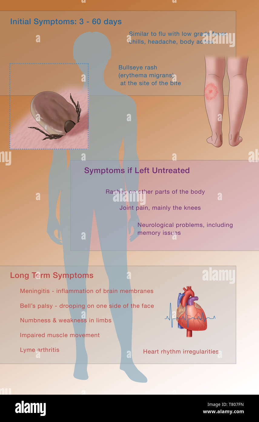 Symptome der Borreliose, Abbildung Stockfoto