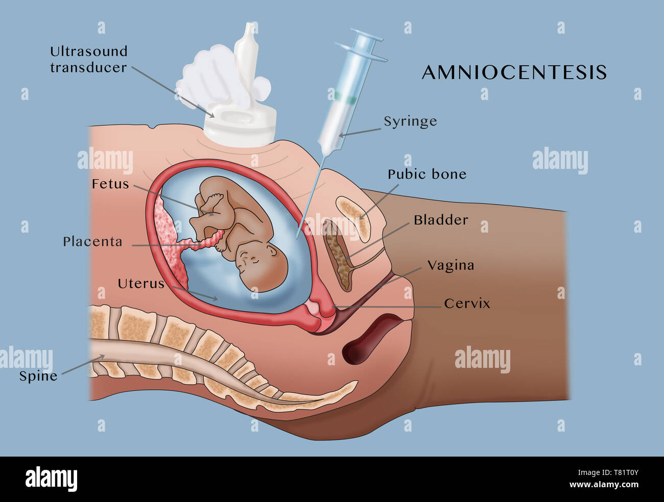 Amniozentese, Abbildung Stockfoto