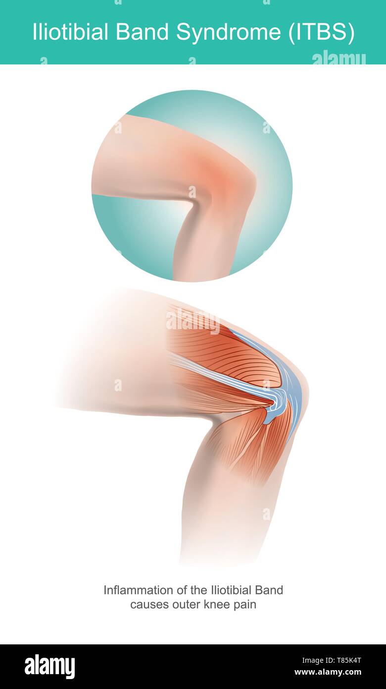 Die Iliotibial Band ist eine Längs faserige Verstärkung der Fascia lata in einem Knie Muskel. Teil der Anatomie des menschlichen Körpers. Abbildung. Stock Vektor