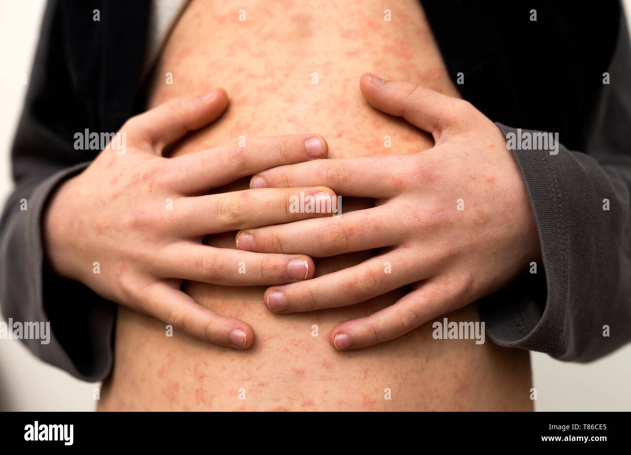Kranken Kind Korper Bauch Mit Roten Rush Spots Von Masern Oder