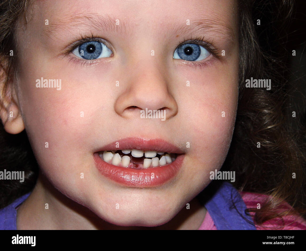 Junges Mädchen mit blauen Augen ihr fehlende Zähne Stockfoto